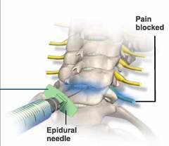 Cervical Epidural - Best Pain Doctor NYC