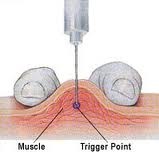 Trigger Point Injections - Best Pain Doctor NYC