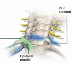 Cervical Radiculopathy - Best Pain Doctor NYC