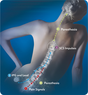 spinal cord stimulator reviews
