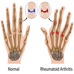 Arthritis, What is it? - Best Pain Doctor NYC