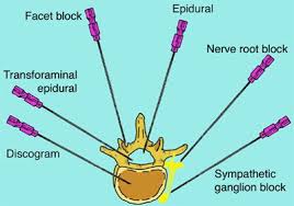 Spinal Injections For Back Pain - Best Pain Doctor NYC